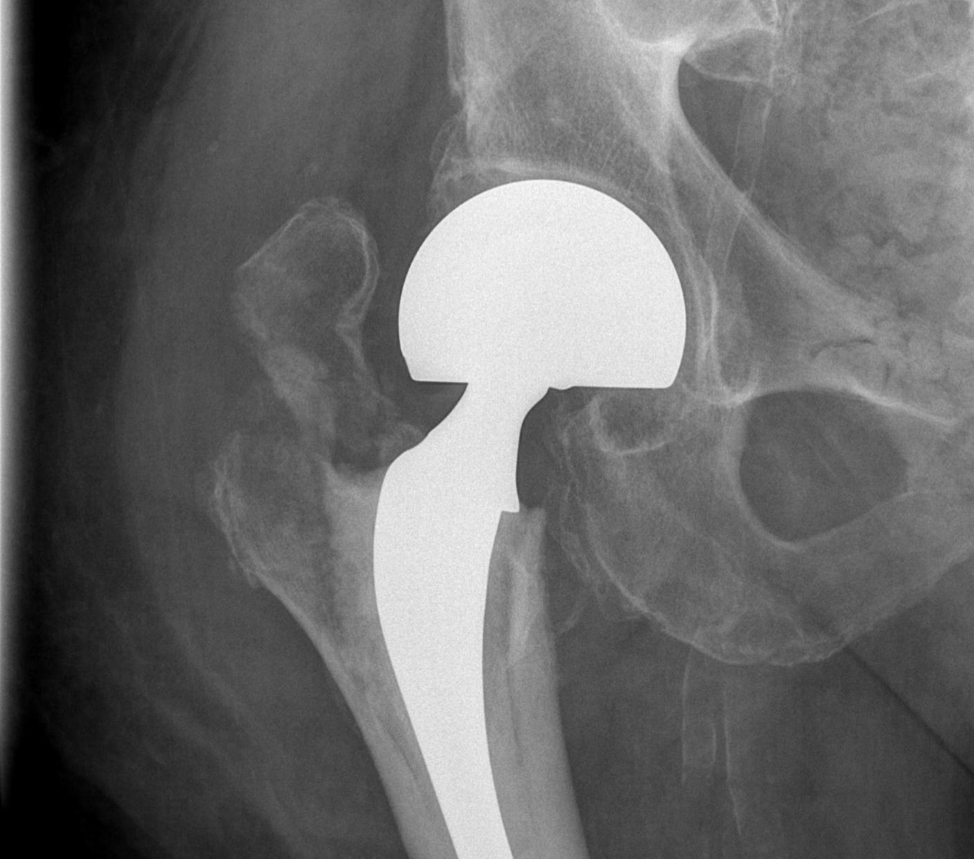 Hip Hemiarthroplasty GT Fracture